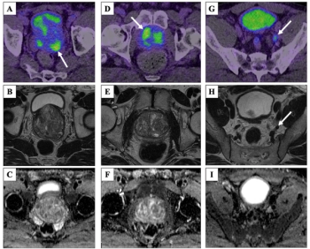 Study Examines Prognostic Value of 68Ga-PSMA-11 PET/CT for Patients at High Risk of PCa