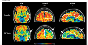 Could MRI-Guided Ultrasound Facilitate Improved Reduction of Amyloid-Beta Load in Patients with Alzheimer’s Disease?