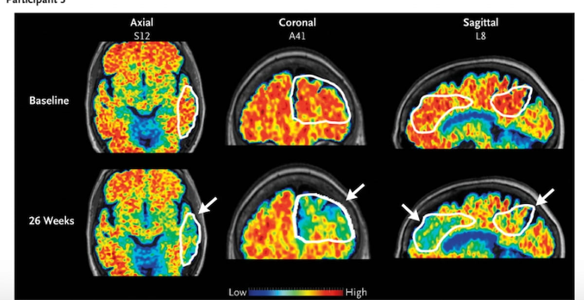Mri Loading Could MRI-Guided Ultrasound Facilitate Improved Reduction of Amyloid ...