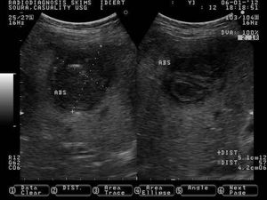 Ascaris Lumbricoides