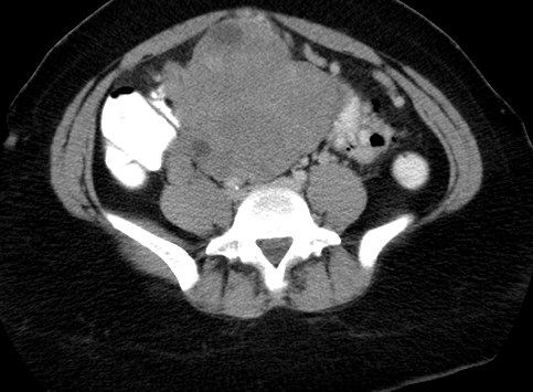 Endometrial Stromal Sarcoma