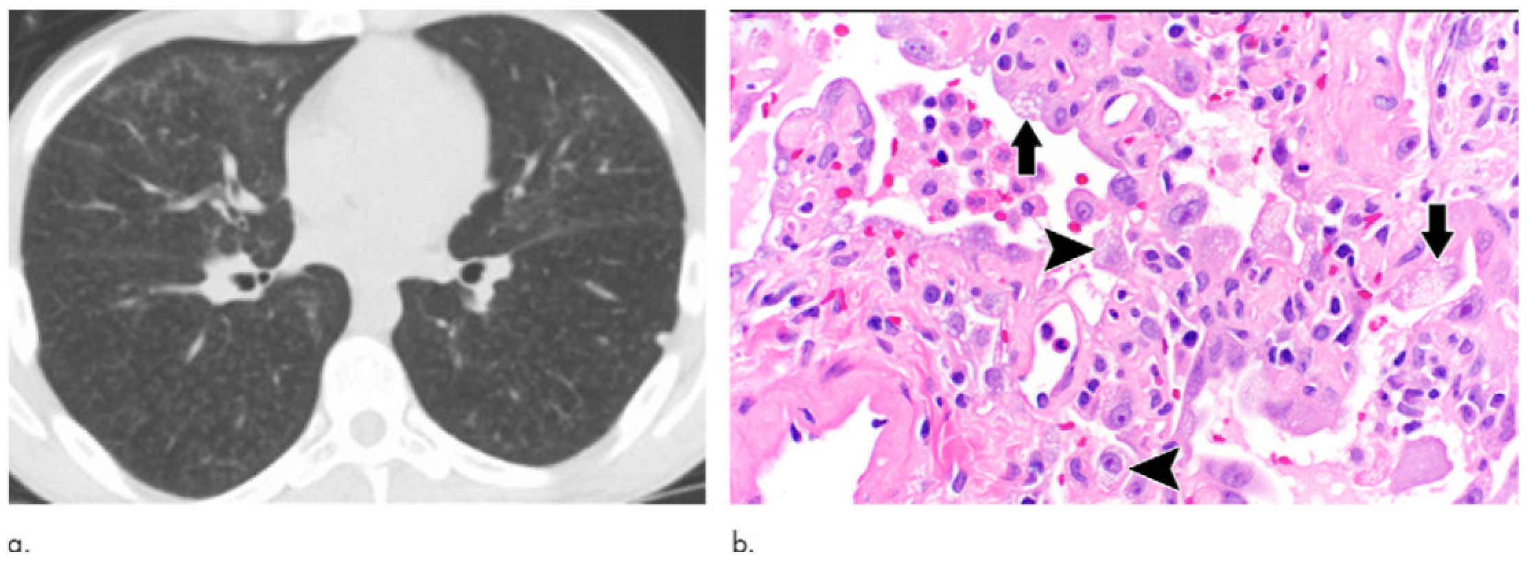 CT Scans Show Vaping-Related Lung Injury Patterns