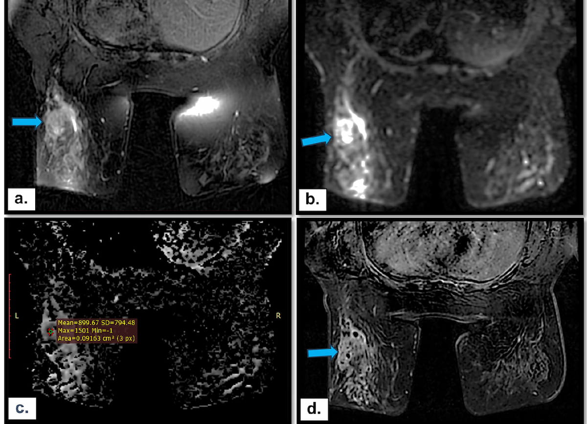 Can Multiparametric MRI Enhance Differentiation of Non-Mass Enhancement Breast Lesions?