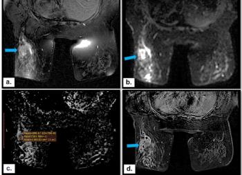 Can Multiparametric MRI Enhance Differentiation of Non-Mass Enhancement Breast Lesions?
