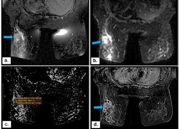 Can Multiparametric MRI Enhance Differentiation of Non-Mass Enhancement Breast Lesions?