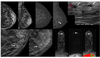 Can Contrast-Enhanced Mammography be a Viable Screening Alternative to Breast MRI?
