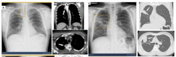 FDA Clears Gleamer’s ChestView AI Software for CXR