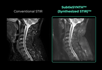 FDA Clears AI Software for Creating Synthetic MRI STIR Images