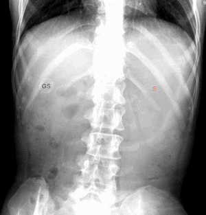 Bedridden Woman With SMA Syndrome