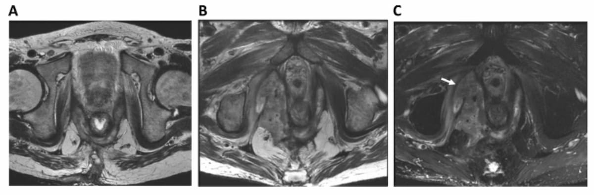 MRI Data in Phase 3 Study Shows Potential Impact of IL-23 Inhibitor for Treating Perianal Fistulizing Crohn’s Disease