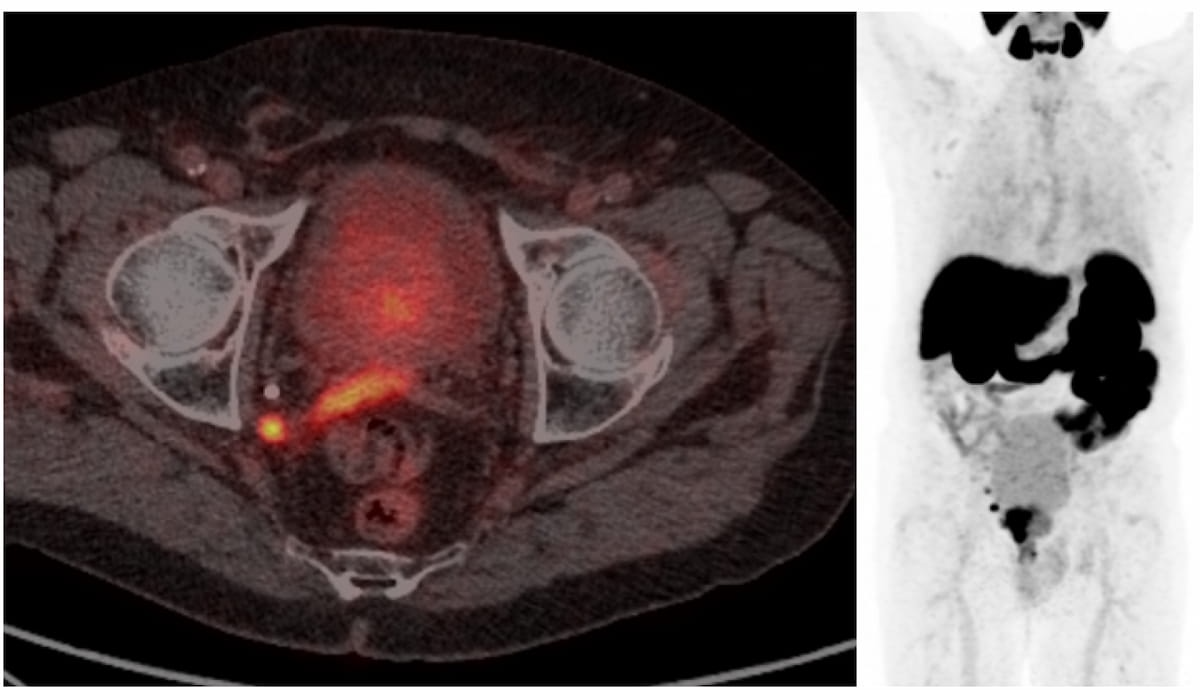 ECR Study Examines Key Predictive Factors for Metastasis in Patients with High-Risk Prostate Cancer