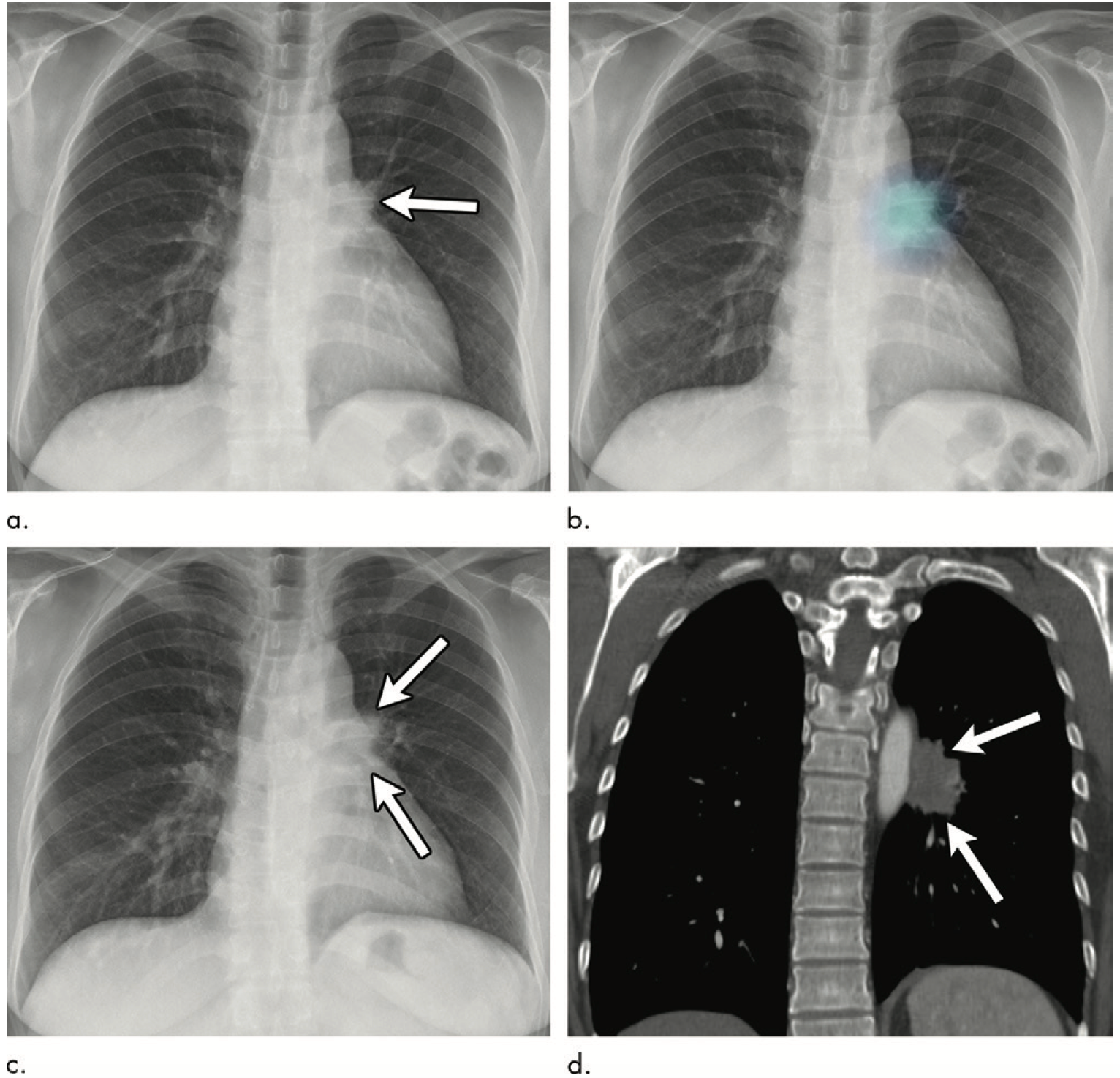 Deep Learning Algorithm Identifies More Missed Lung Cancers On X Ray