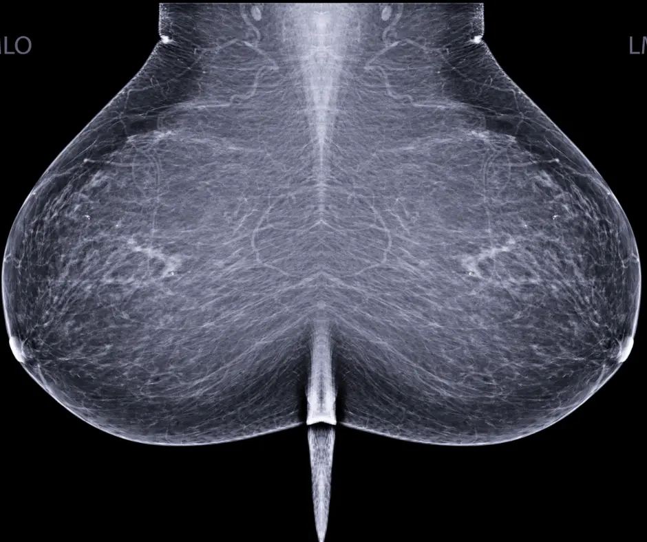 Mammography News: FDA Says National Breast Density Notification Rule May be Published in Late 2022 or Early 2023