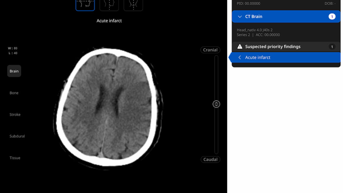 FDA Clears Adjunctive AI Software for Acute Infarct Triage with Non-Contrast CT