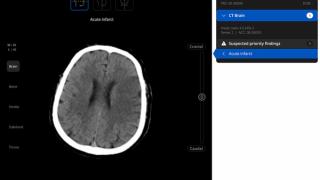 FDA Clears Adjunctive AI Software for Acute Infarct Triage with Non-Contrast CT