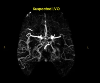 Comparative AI Study Shows Merits of RapidAI LVO Software in Stroke Detection