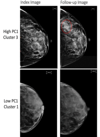 Can Radiomic Parenchymal Phenotypes Derived from Mammography Enhance Risk Stratification for Breast Cancer?