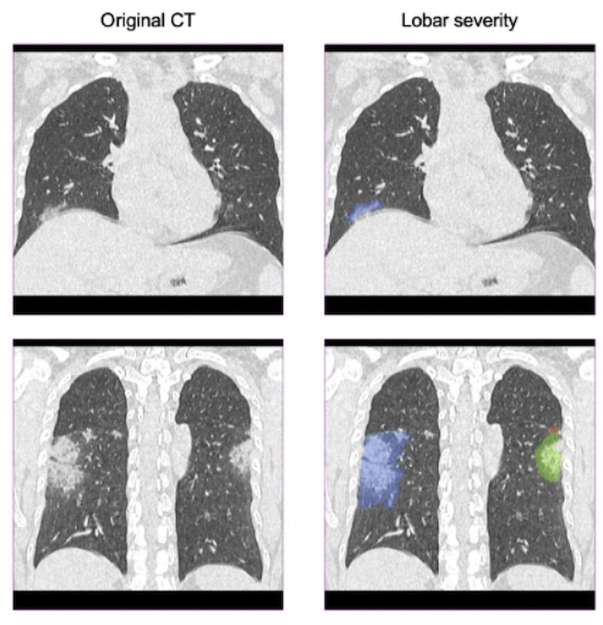 FDA Clears Updated AI Software for Lung CT