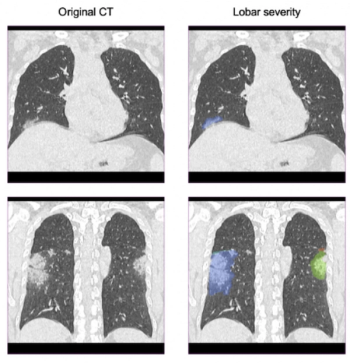 FDA Clears Updated AI Software for Lung CT