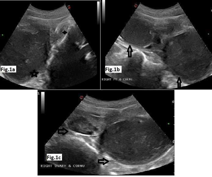 mullerian agenesis ultrasound