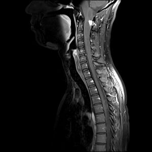 Image IQ: 34-year-old Male, Worsening Numbness and Weakness