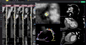 Multicenter Study Shows Capability of AI CCTA Analysis for Predicting Major Adverse Cardiovascular Events