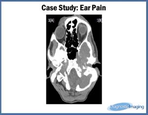 Ear Pain