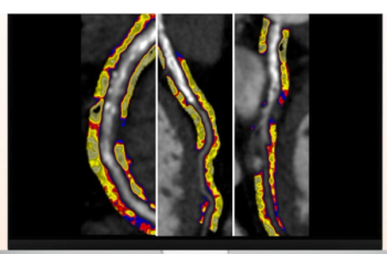 AMA Approves Category III CPT Codes for AI-Enabled Perivascular Fat Analysis from CT Scans 