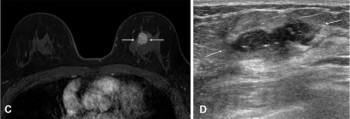 Study: Pre-Op MRI Makes No Difference in Outcomes for Women with HER-2 Positive, Hormone-Receptor Negative Breast Cancer