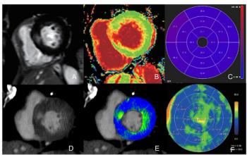 Can Photon-Counting CT Bolster Myocardial Extracellular Volume Quantification Beyond EID-CT?