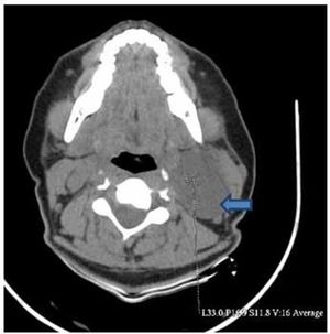 Peripheral Nerve Sheath Tumor of Cervical Vagus Nerve