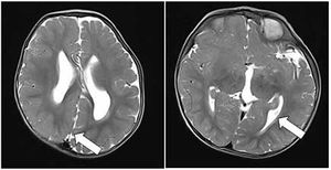 Hemimegencephaly