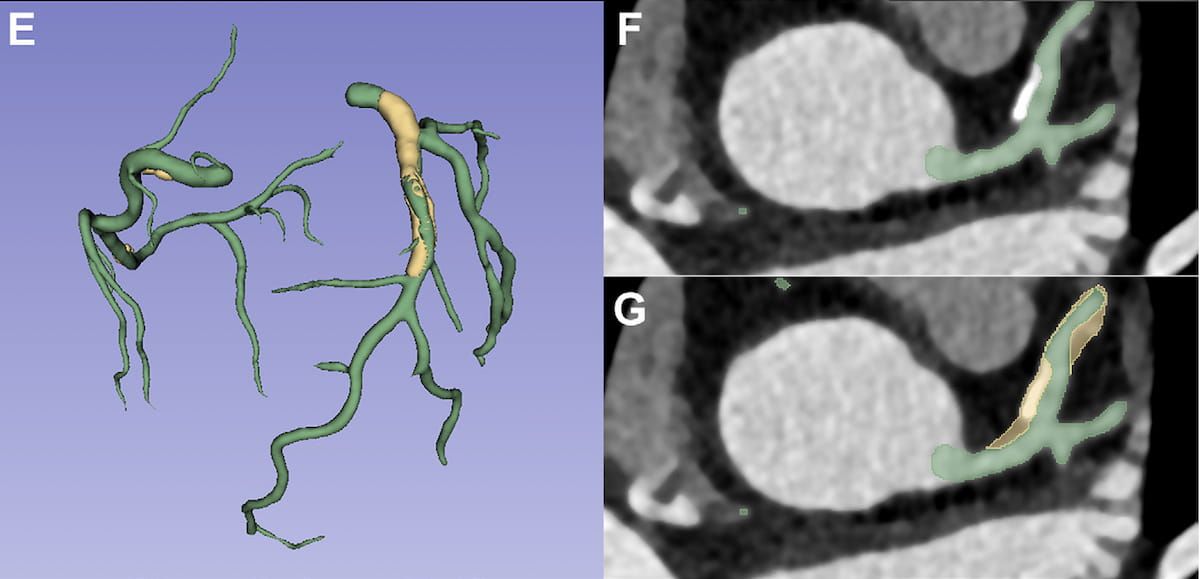 Quantifying Coronary Plaque on CCTA: Can a Fully Automated AI Model Have an Impact?