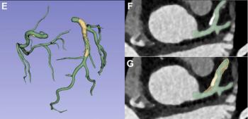 Quantifying Coronary Plaque on CCTA: Can a Fully Automated AI Model Have an Impact?