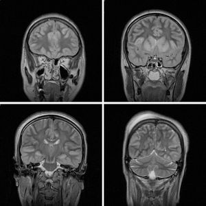 MRI Findings in Attempted Hanging