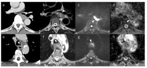 Does MRI Provide Better Staging of Esophageal Cancer than CT?