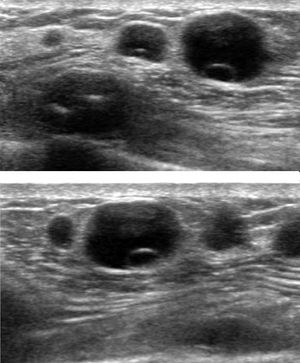 Liponecrotic Nodules After Autologous Fat Transfer For Breast Augmentation