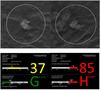 Mammography Study Suggests DBT-Based AI May Help Reduce Disparities with Breast Cancer Screening
