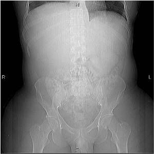 Adrenal Cortical Carcinoma