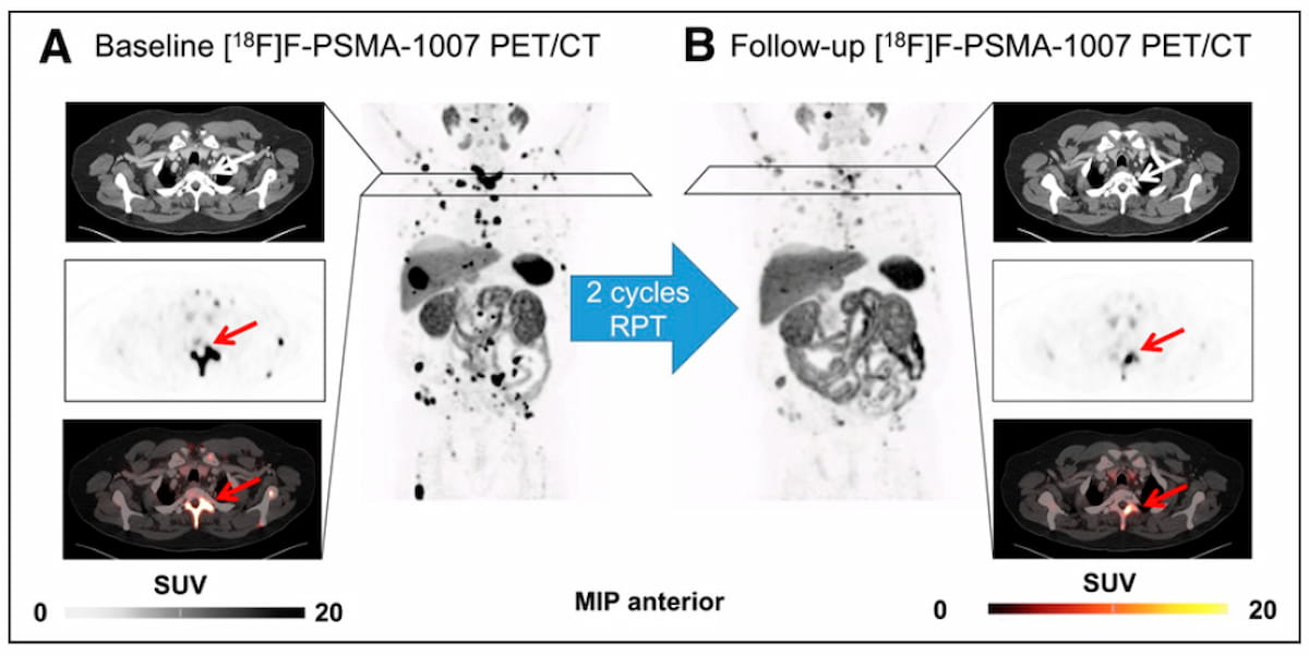  Can PET Imaging Predict Treatment Outcomes for the 225Ac-labeled PSMA Radiopharmaceutical in Patients with mCRPC?