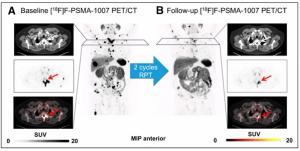  Can PET Imaging Predict Treatment Outcomes for the 225Ac-labeled PSMA Radiopharmaceutical in Patients with mCRPC?