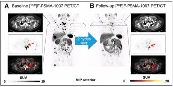 Can PET Imaging Predict Treatment Outcomes for the 225Ac-labeled PSMA Radiopharmaceutical in Patients with mCRPC?