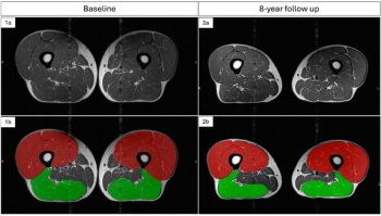 MRI Study Emphasizes Exercise Over Weight Loss in Preserving Muscle Volume for Overweight Patients at Risk for Knee OA