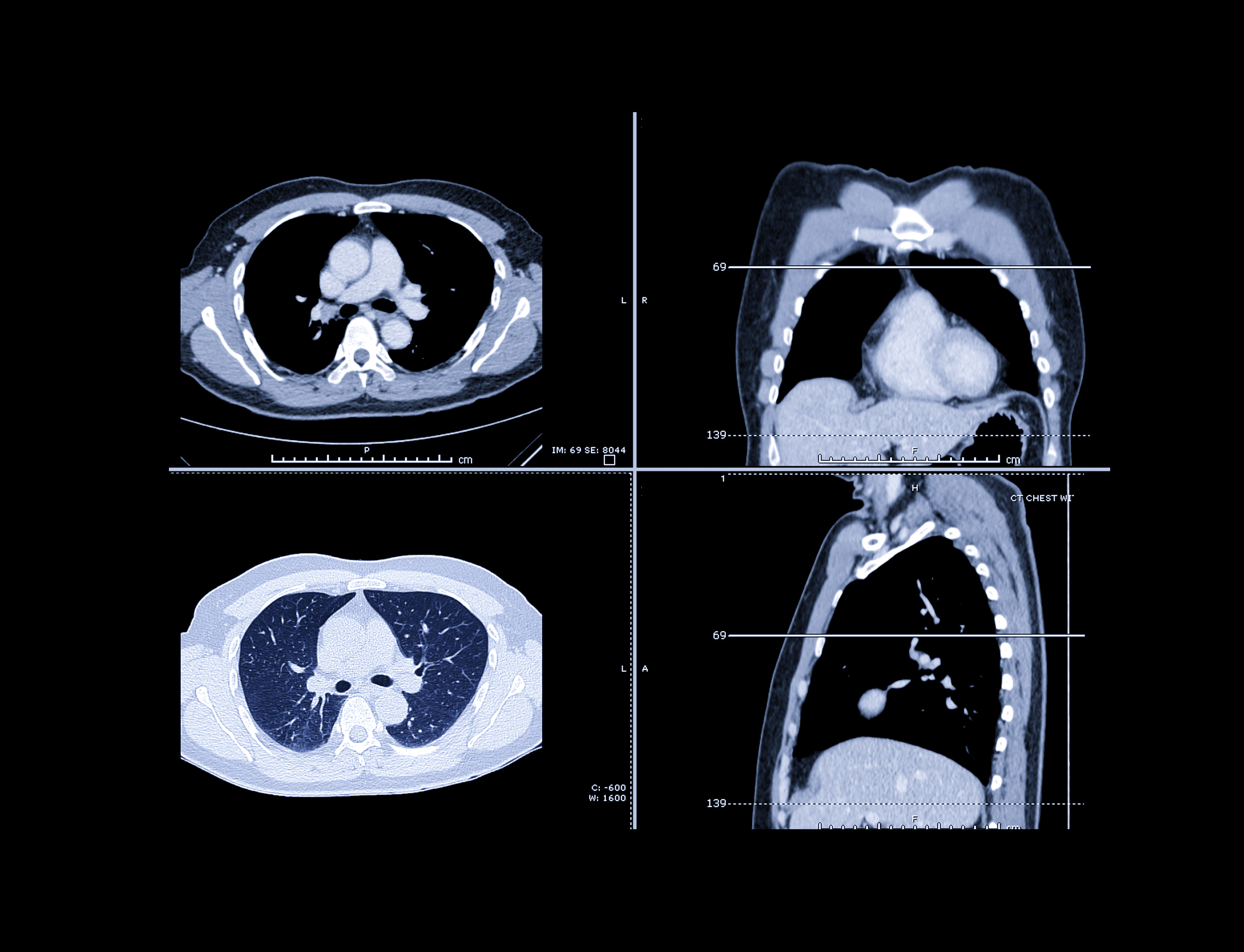 Lung rads 2. Компьютерная томография легких на экране. Кт легких Сток. Кт скрининг.
