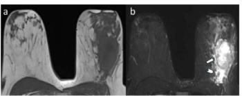 Breast MRI Study Links Peritumoral Edema to Reduced Disease-Free Survival from Breast Cancer in Young Women 