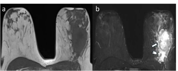 Breast MRI Study Links Peritumoral Edema to Reduced Disease-Free Survival from Breast Cancer in Young Women 