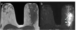Breast MRI Study Links Peritumoral Edema to Reduced Disease-Free Survival from Breast Cancer in Young Women