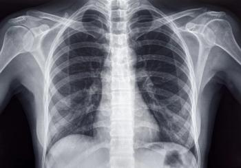 Generative Vision Language Model for Chest X-Ray Gets FDA’s Breakthrough Device Designation 