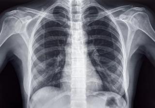 Generative Vision Language Model for Chest X-Ray Gets FDA’s Breakthrough Device Designation