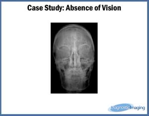 Absence of Vision